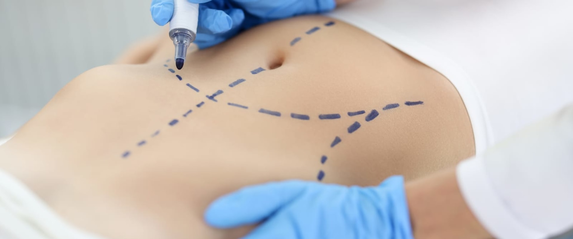 Enhance Comfort and Confidence: Liposuction for Back Injuries