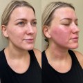 From Recovery To Renewal: Plastic Surgery In Danville, California After Back Injury Challenges