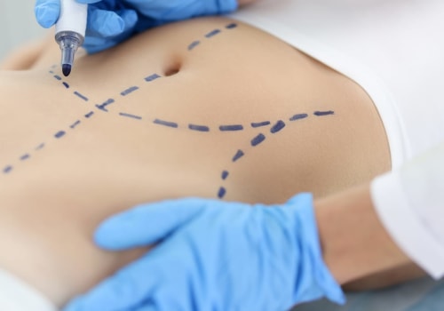 Enhance Comfort and Confidence: Liposuction for Back Injuries